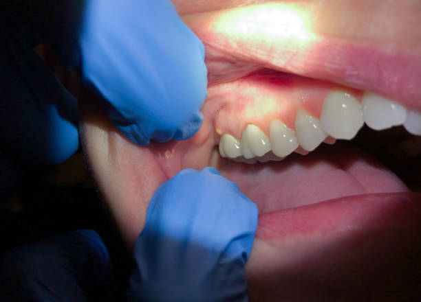 Best Emergency Tooth Extraction in Combine, TX