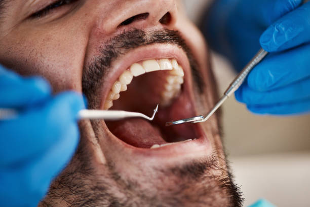 Best Emergency Root Canal Treatment in Combine, TX