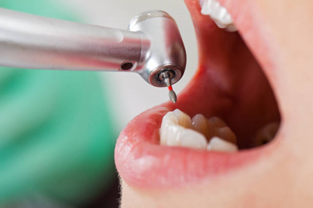 Best Emergency Treatment for Dental Infections or Abscesses in Combine, TX
